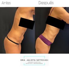 Abdominoplastia - Dra. Julieta Settecasi