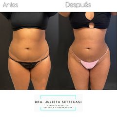 Liposucción HD + aumento glúteo - Dra. Julieta Settecasi