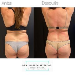 Abdominoplastia - Dra. Julieta Settecasi