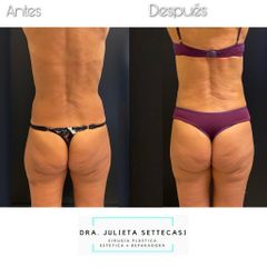 Liposucción - Dra. Julieta Settecasi