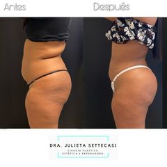 Liposucción HD + aumento glúteo - Dra. Julieta Settecasi