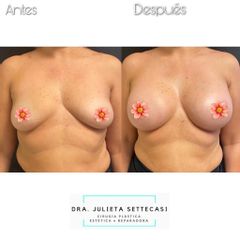 Aumento mamas  - Dra. Julieta Settecasi
