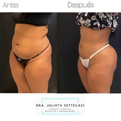Liposucción HD + lipoinjerto glúteo - Dra. Julieta Settecasi