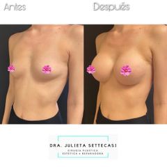Aumento mamas  - Dra. Julieta Settecasi
