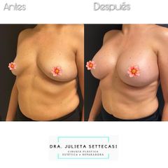 Aumento mamas - Dra. Julieta Settecasi