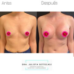 Aumento mamas  - Dra. Julieta Settecasi