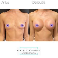 Aumento mamas - Dra. Julieta Settecasi