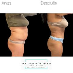 Abdominoplastia - Dra. Julieta Settecasi
