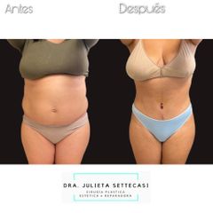 Abdominoplastia - Dra. Julieta Settecasi