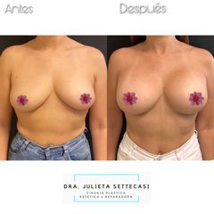 Aumento mamas  - Dra. Julieta Settecasi