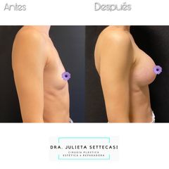 Aumento mamas  - Dra. Julieta Settecasi
