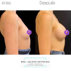 Aumento mamas  - Dra. Julieta Settecasi