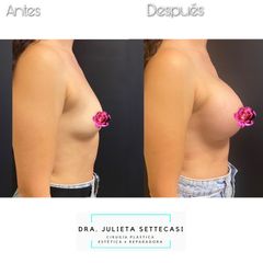 Aumento mamas  - Dra. Julieta Settecasi