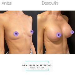 Aumento mamas - Dra. Julieta Settecasi