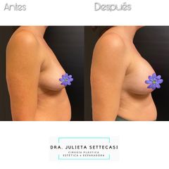 Aumento mamas  - Dra. Julieta Settecasi