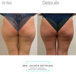 Liposucción - Dra. Julieta Settecasi