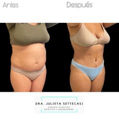 Abdominoplastia - Dra. Julieta Settecasi