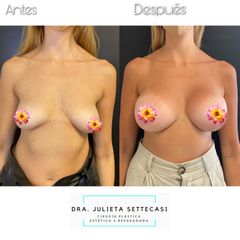 Mastopexia - Dra. Julieta Settecasi