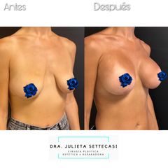Mastopexia - Dra. Julieta Settecasi