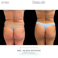 Liposucción - Dra. Julieta Settecasi