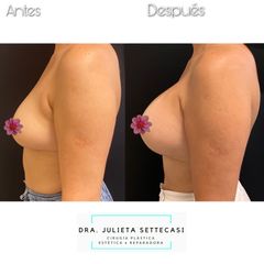Aumento mamas  - Dra. Julieta Settecasi