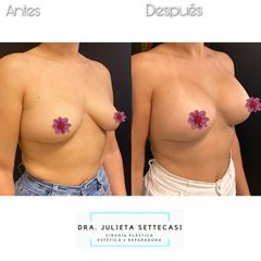 Aumento mamas  - Dra. Julieta Settecasi