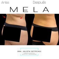 Liposucción - Dra. Julieta Settecasi