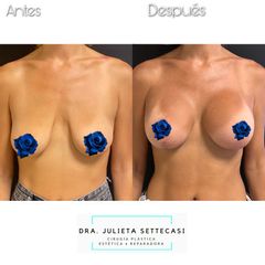 Mastopexia - Dra. Julieta Settecasi