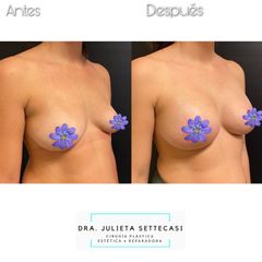 Aumento mamas - Dra. Julieta Settecasi