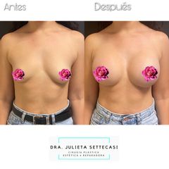 Aumento mamas  - Dra. Julieta Settecasi