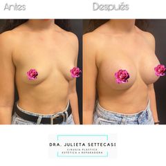 Aumento mamas  - Dra. Julieta Settecasi