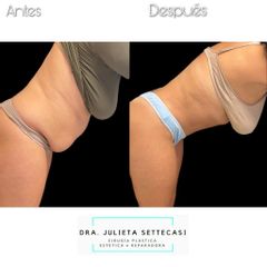 Abdominoplastia - Dra. Julieta Settecasi