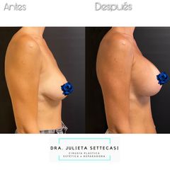 Aumento mamas  - Dra. Julieta Settecasi