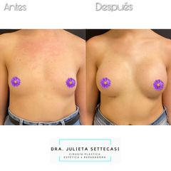 Aumento mamas  - Dra. Julieta Settecasi