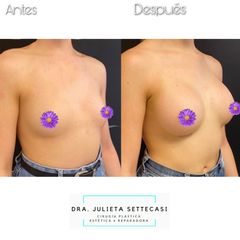 Aumento mamas  - Dra. Julieta Settecasi