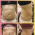 Lipo con renuvio j plasma