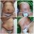 Mi abdominoplastia después de tanto  estoy feliz!!
