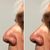 Experiencia rinoplastia - Rhinoplasty Experience