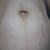 Hola chicas!!! Les cuento que después de investigar tantos tratamientos para eliminar las estrias que me salieron en el abdomen despues de mi embarazo,me decidí a empezar la carboxiterapia.