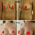 1 mes: mastopexia + implantes