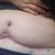 Dermolipectomia con lipo. Dr, Adolfo Lopez Rosende