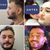 RINOMODELACIÓN CON Juvederm Volux