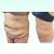Sueño Cumplido abdominoplastia