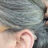 Reducción de oreja, cierre de lóbulo por expansor