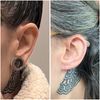 Reducción de oreja, cierre de lóbulo por expansor