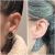 Reducción de oreja, cierre de lóbulo por expansor