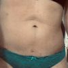 El tratamiento que me salvo la lipo tras el postoperatorio de lipo