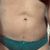 El tratamiento que me salvo la lipo tras el postoperatorio de lipo
