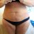 Logré lo que toda mujer desea: un abdomen plano con la dermolipectomía