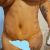 Dermolipectomia con lipo